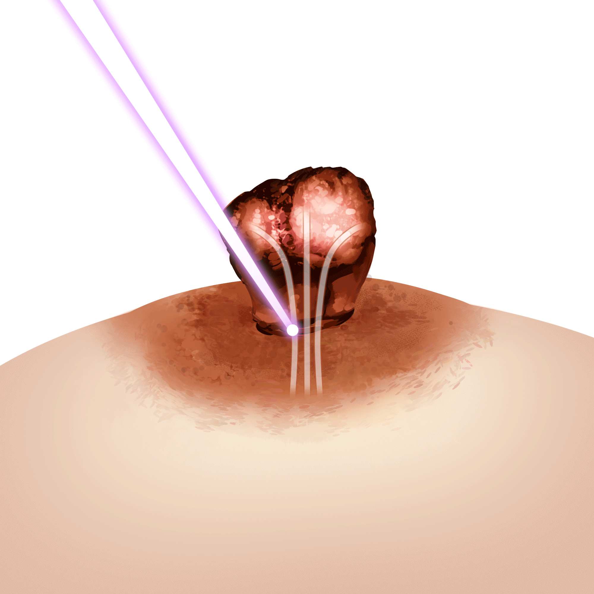 유두 축소 레이저 정면