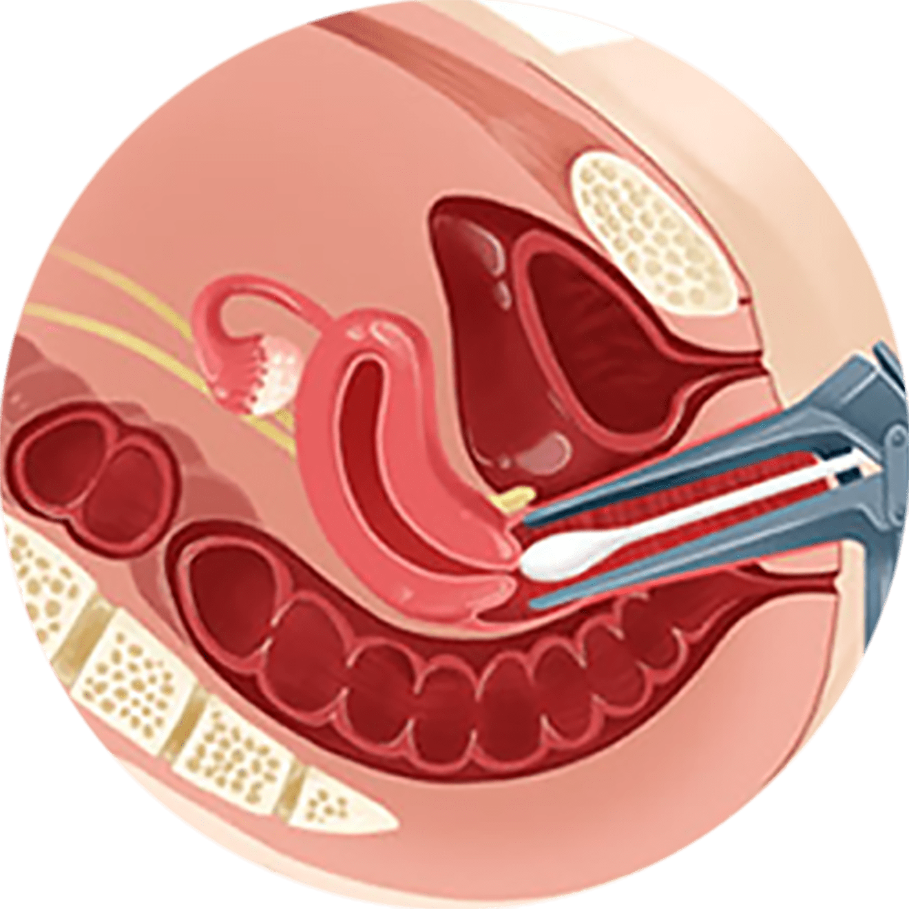 자궁경부암 세포검사