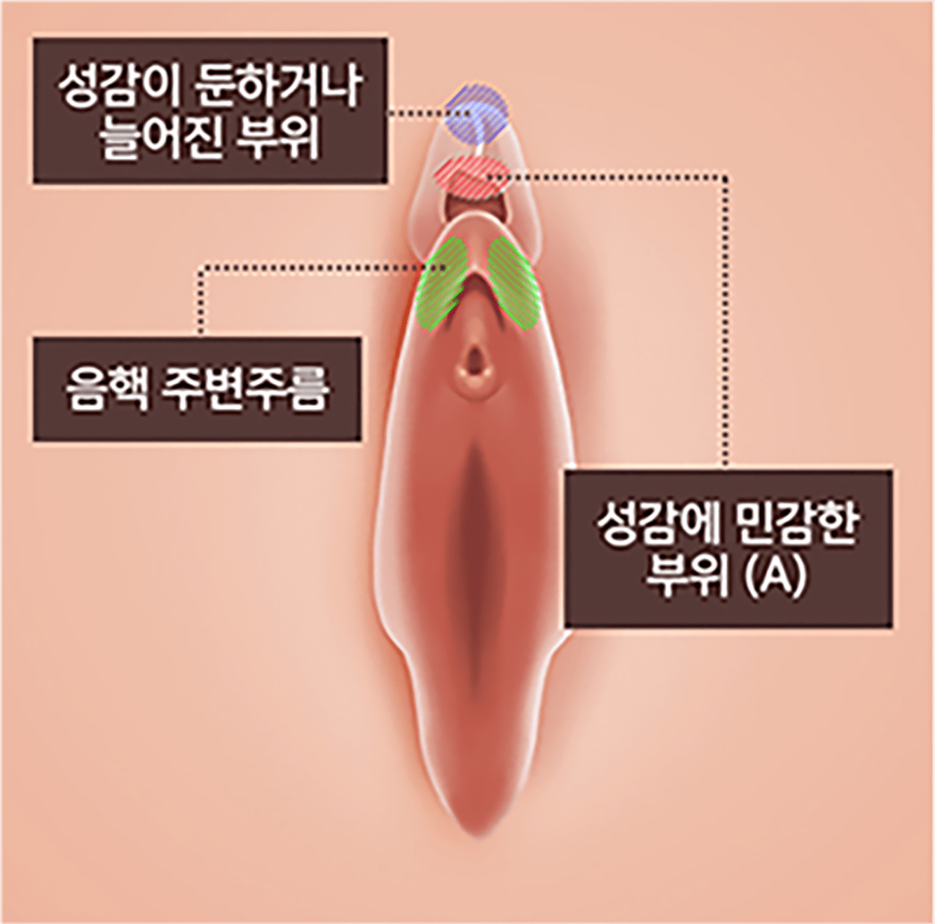 음핵커플술