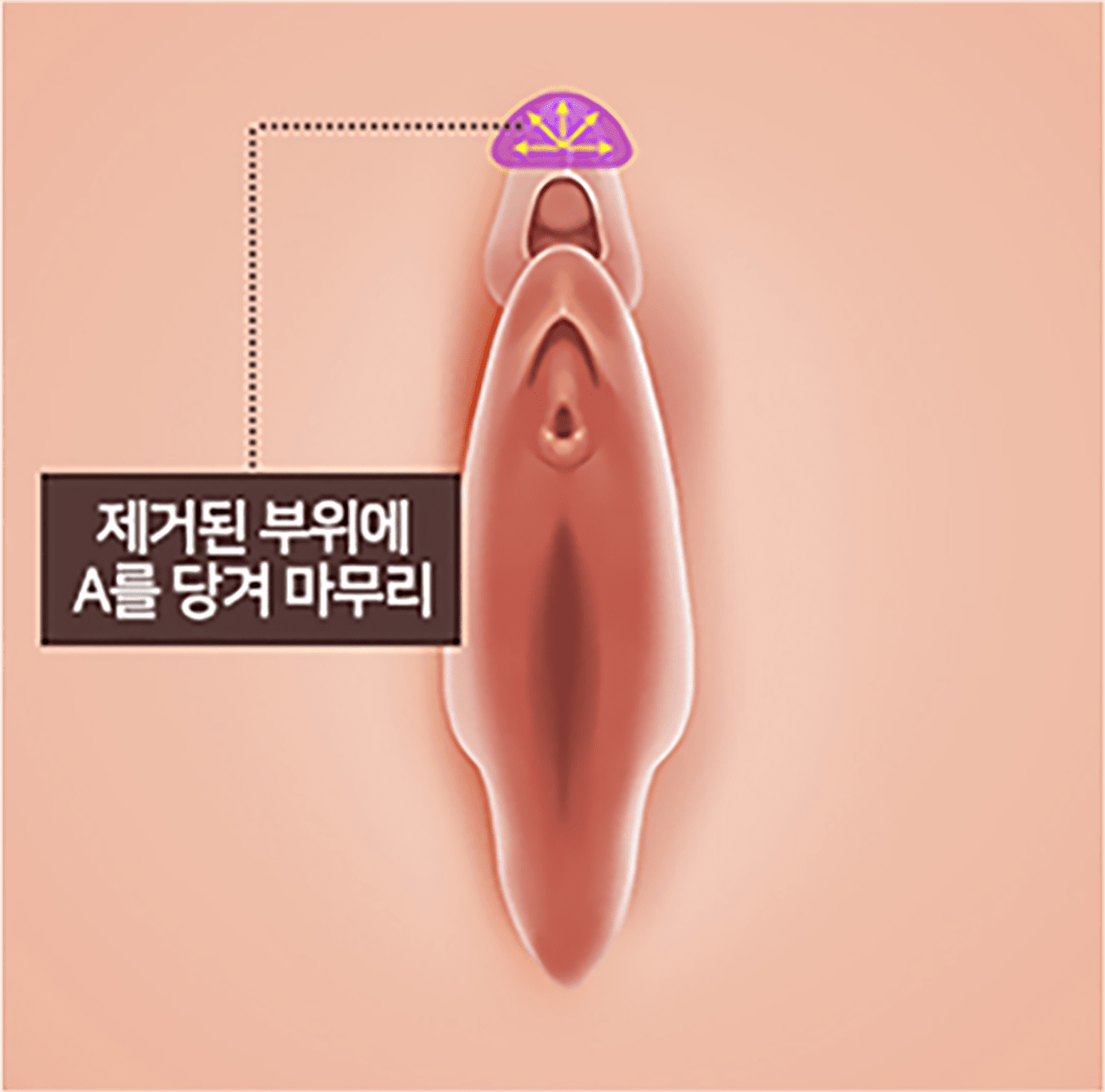 음핵커플술