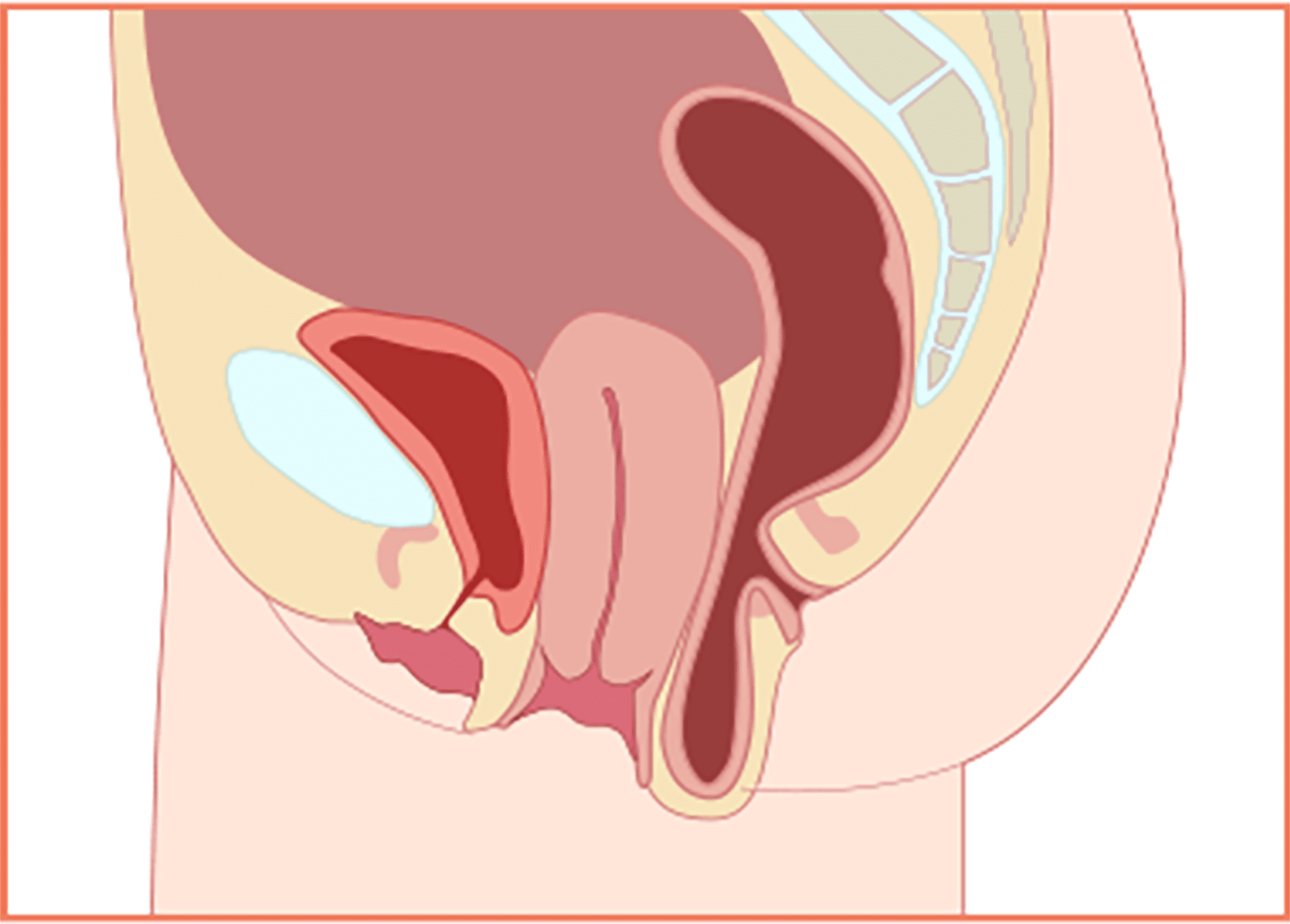 질탈출 자궁하수