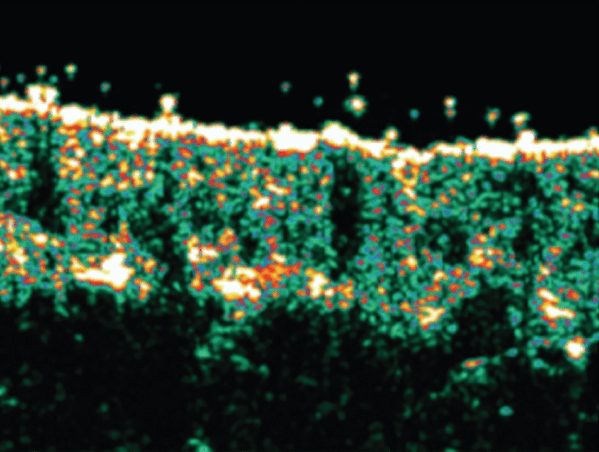 시술 전 피부 두께