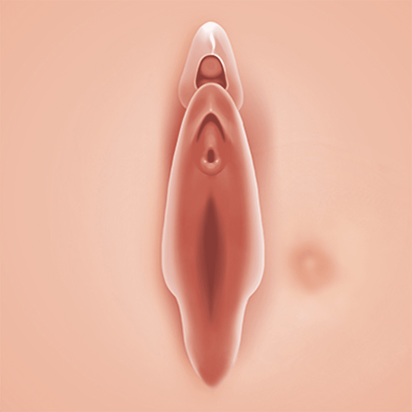 외음부 피지 낭종