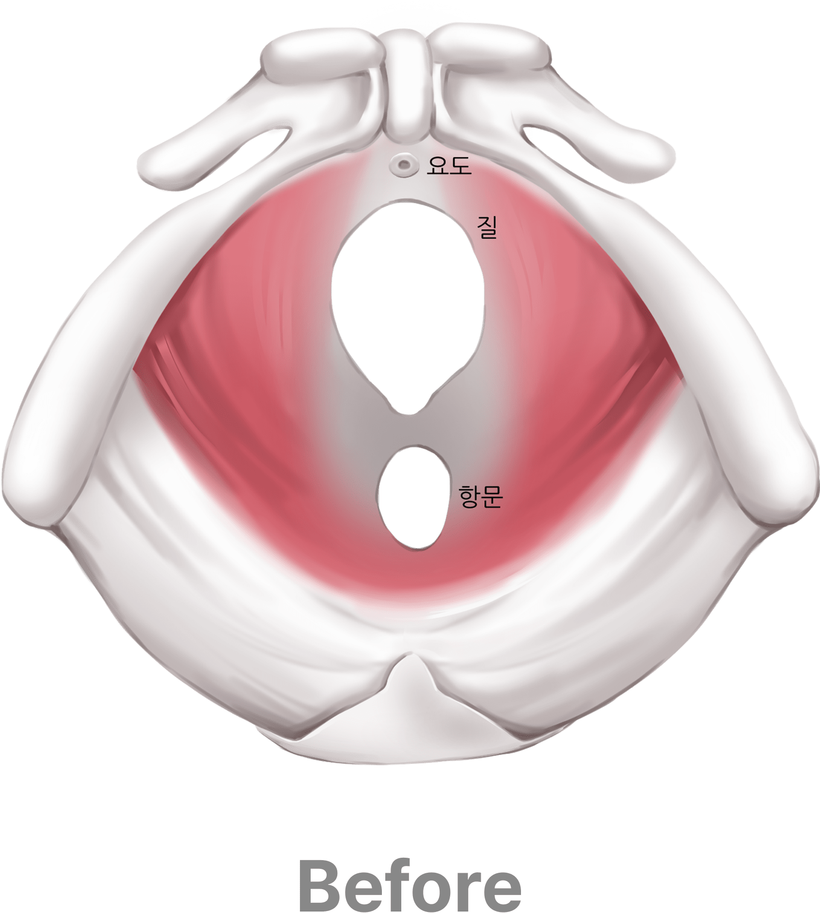 질 축소술 단면도 뼈