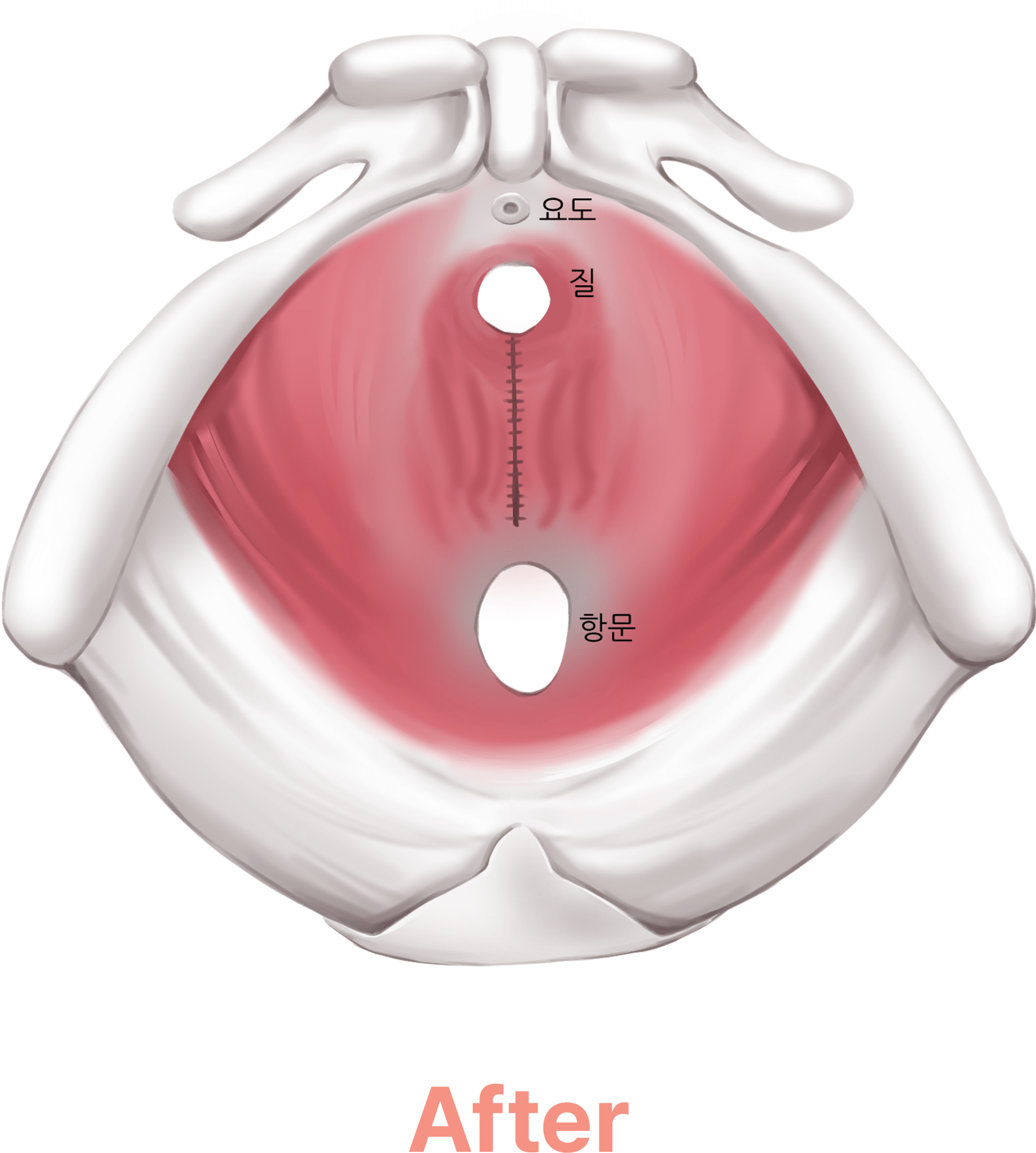 질 축소술 단면도 뼈