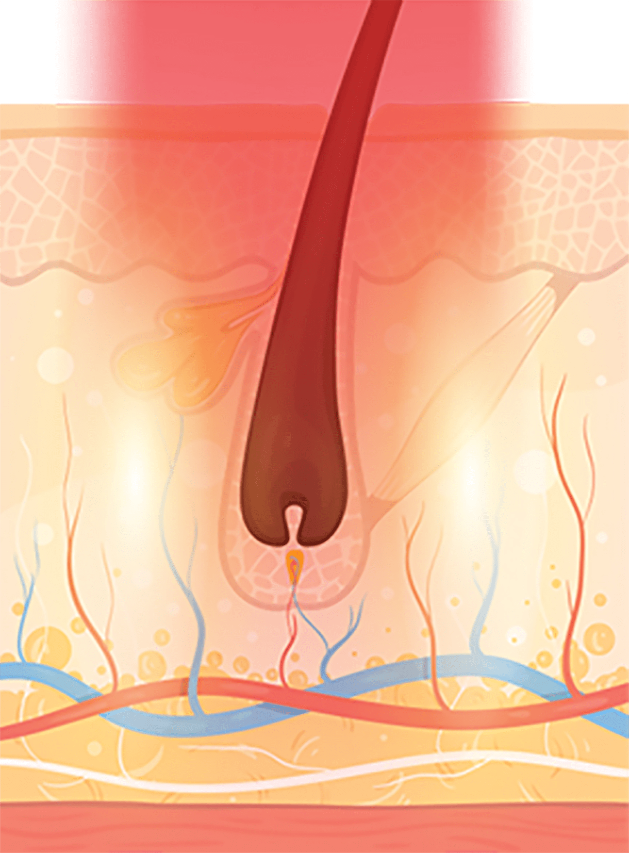 레이저 조사 - 모낭 공격