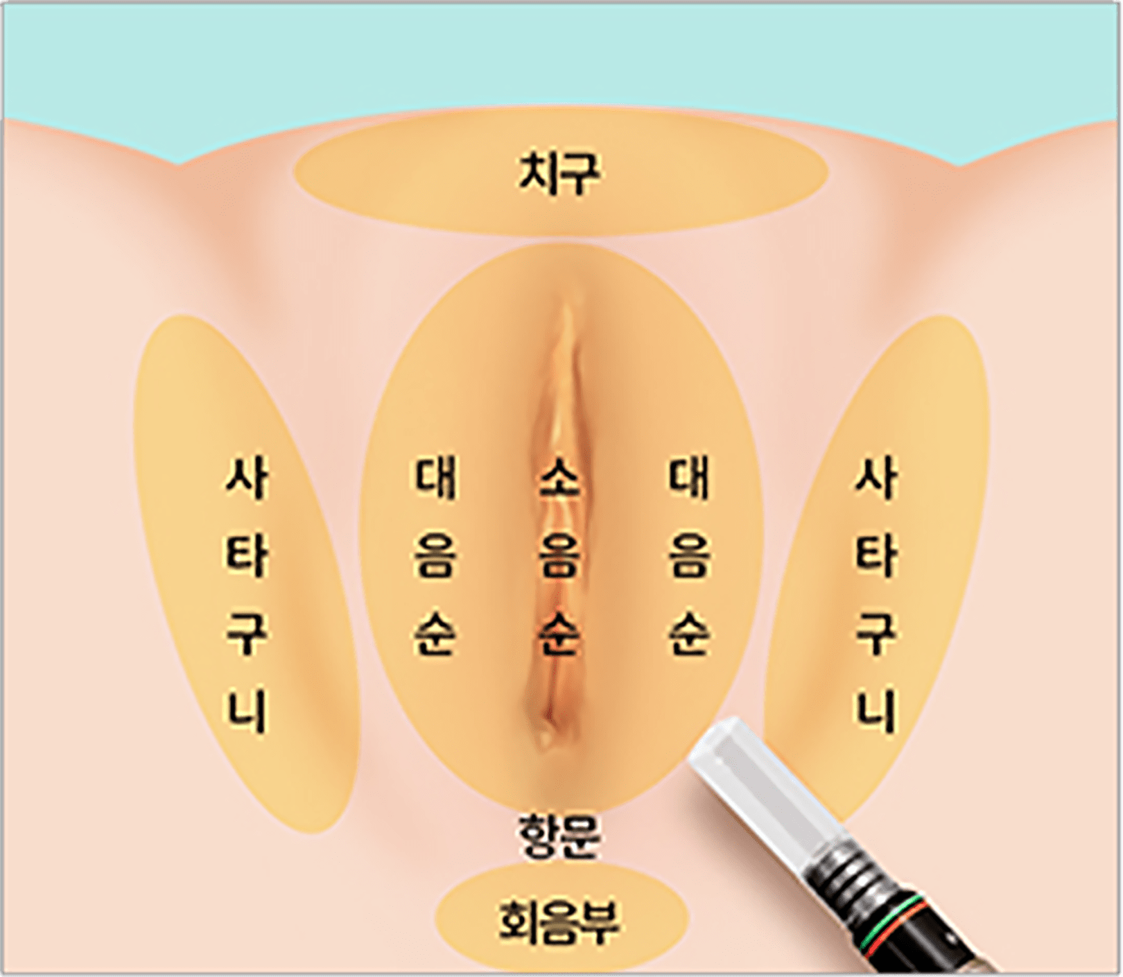 필요한 부위에 레이저 조사
